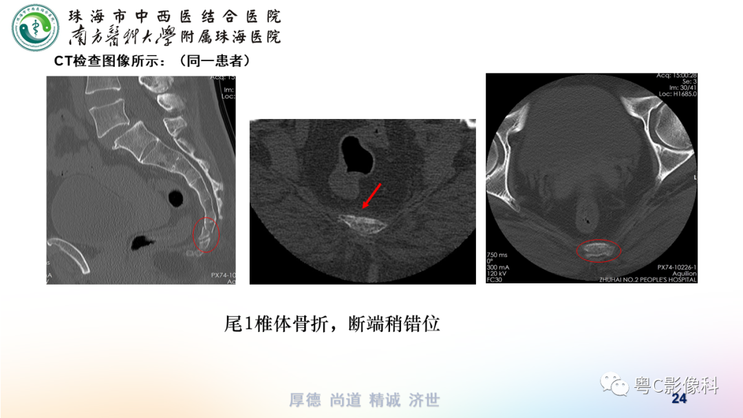 影像PPT - 【PPT】骶尾骨正侧位X线摄影-24