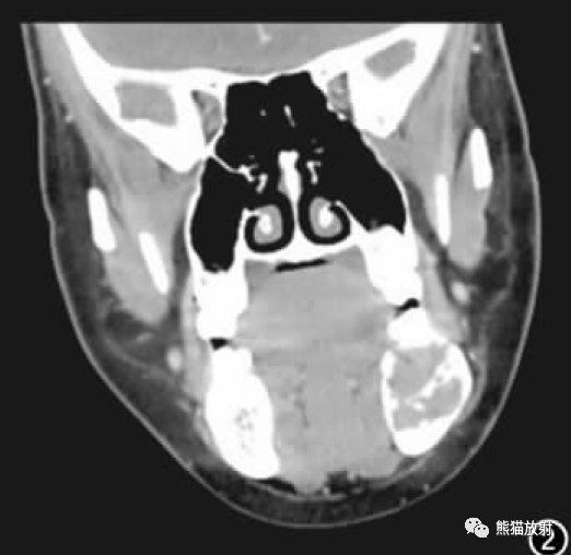 影像PPT - 【病例】下颌骨中心性巨细胞肉芽肿1例CT影像-2 影像PPT - 【病例】下颌骨中心性巨细胞肉芽肿1例CT影像-2
