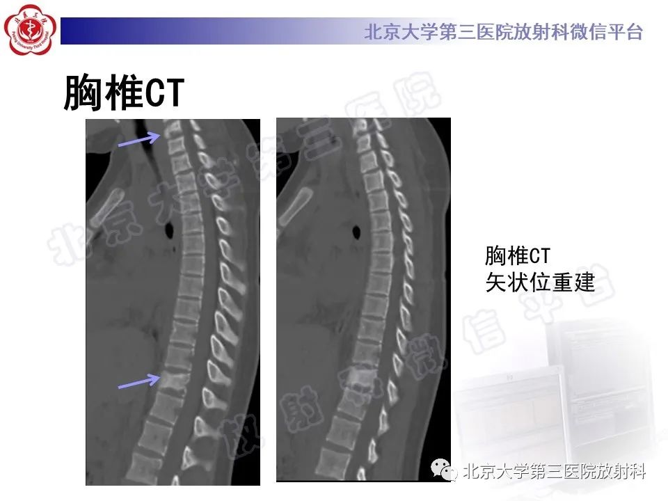 影像PPT - 【PPT】慢性复发性多灶性骨髓炎-3