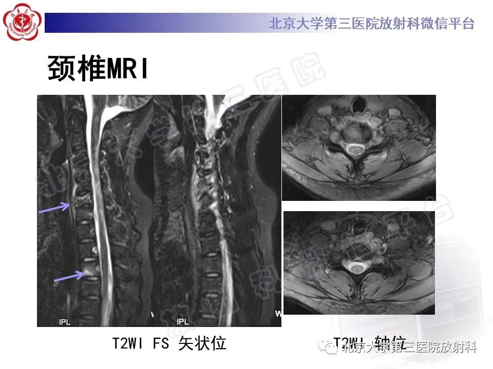 影像PPT - 【PPT】慢性复发性多灶性骨髓炎-5