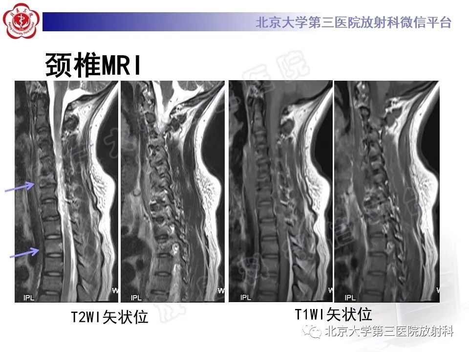影像PPT - 【PPT】慢性复发性多灶性骨髓炎-4