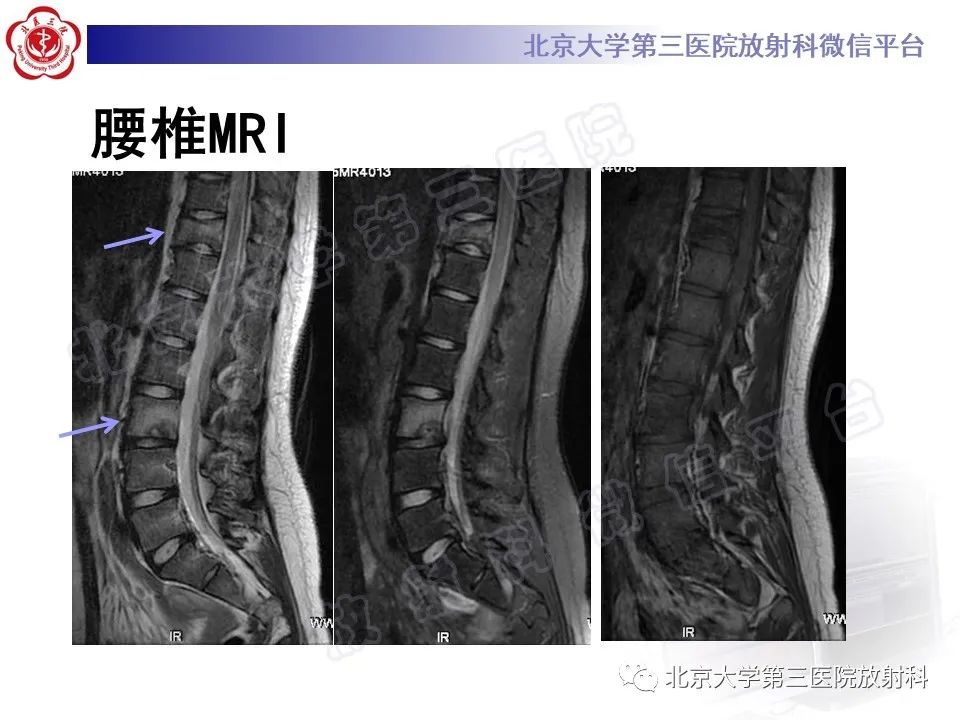 影像PPT - 【PPT】慢性复发性多灶性骨髓炎-6