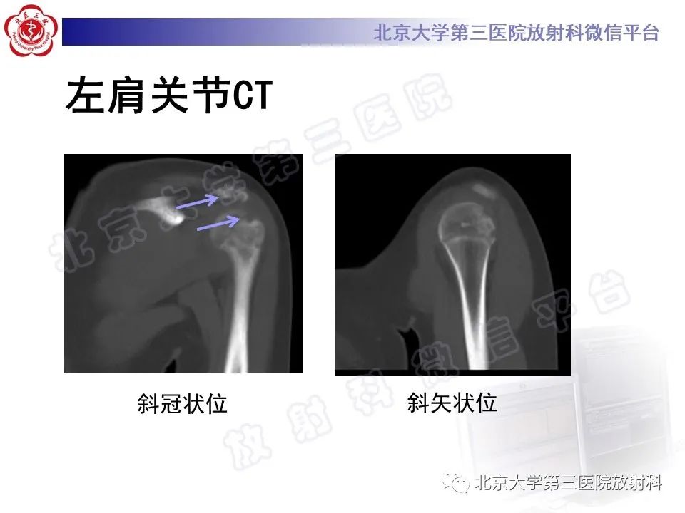 影像PPT - 【PPT】慢性复发性多灶性骨髓炎-8