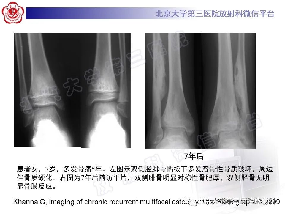 影像PPT - 【PPT】慢性复发性多灶性骨髓炎-24