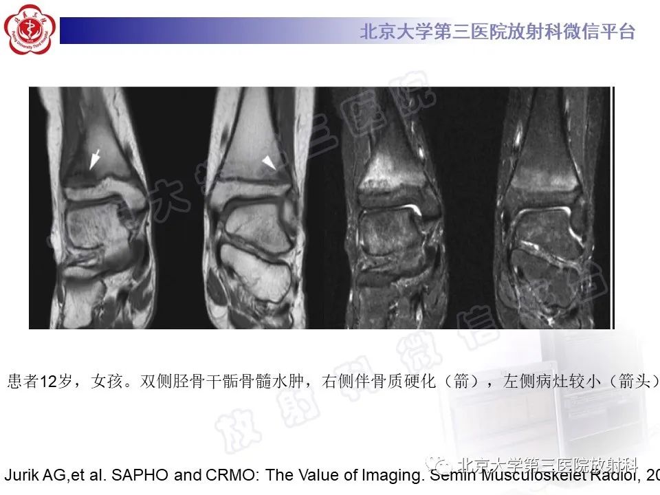 影像PPT - 【PPT】慢性复发性多灶性骨髓炎-25