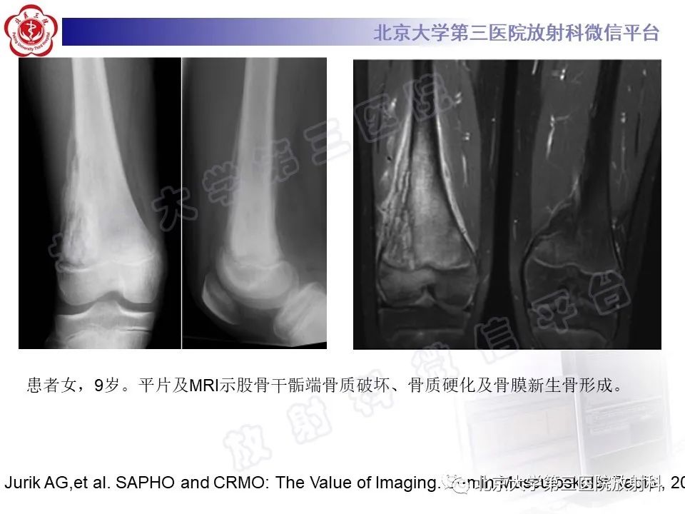 影像PPT - 【PPT】慢性复发性多灶性骨髓炎-26