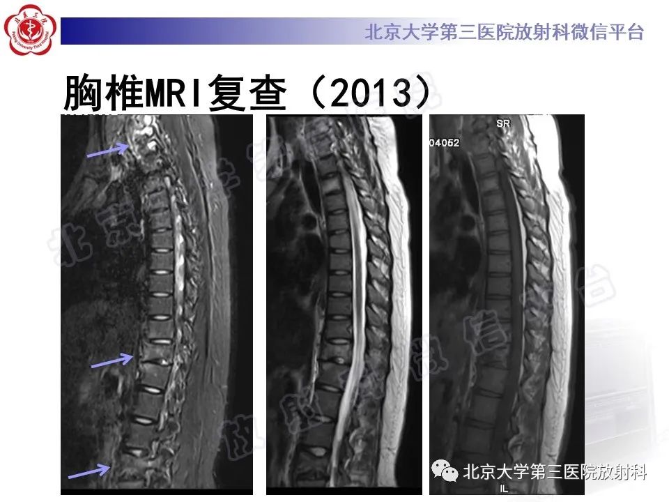 影像PPT - 【PPT】慢性复发性多灶性骨髓炎-11