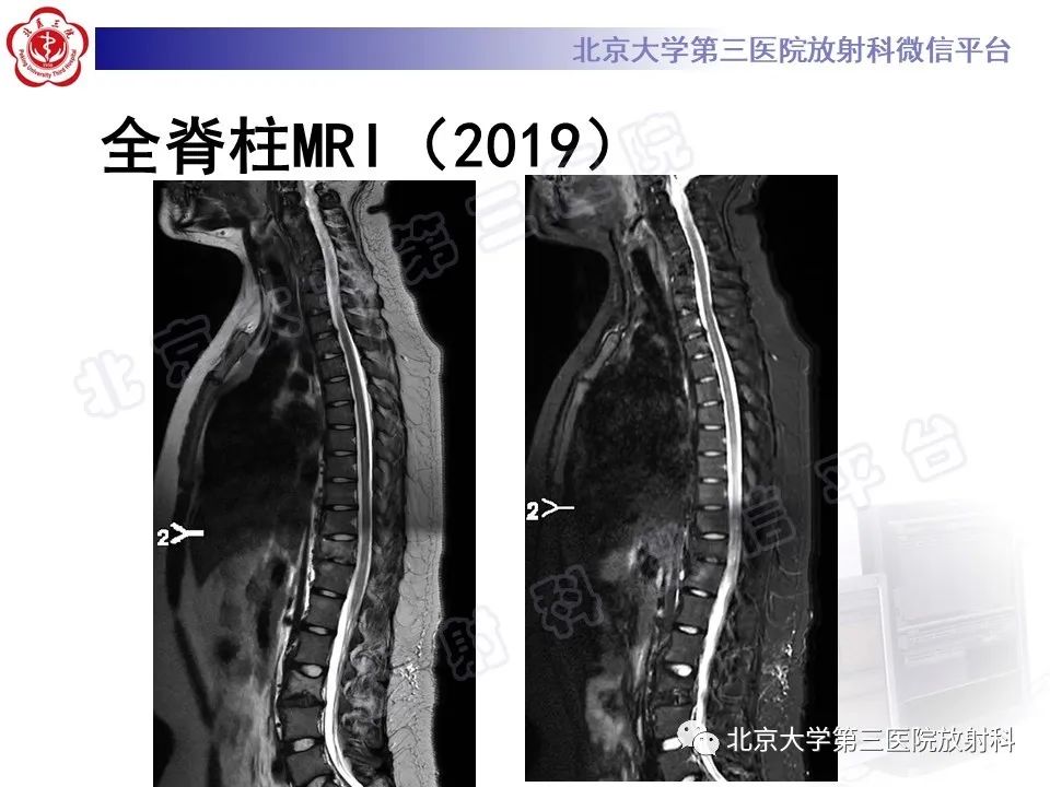 影像PPT - 【PPT】慢性复发性多灶性骨髓炎-12