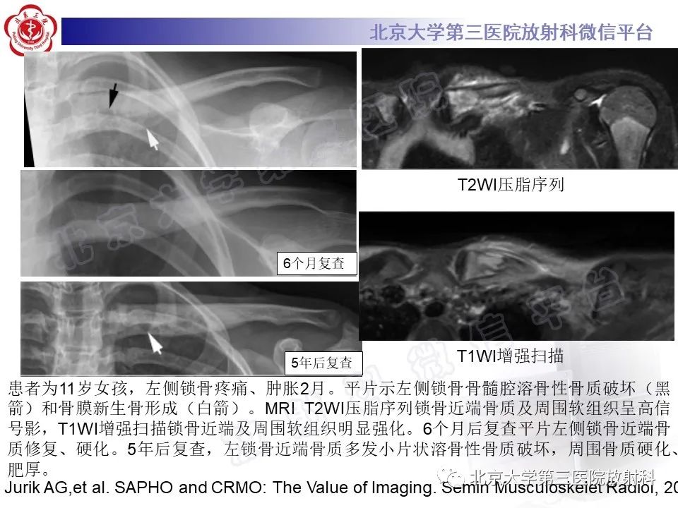 影像PPT - 【PPT】慢性复发性多灶性骨髓炎-29