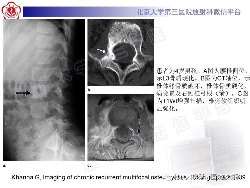 影像PPT - 【PPT】慢性复发性多灶性骨髓炎-32