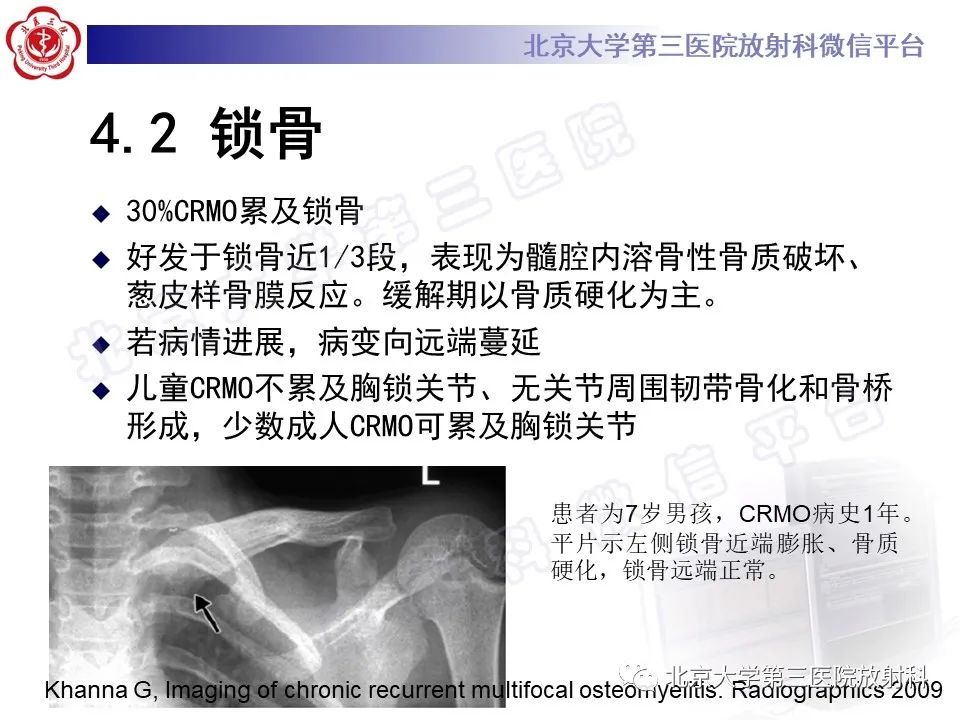 影像PPT - 【PPT】慢性复发性多灶性骨髓炎-28