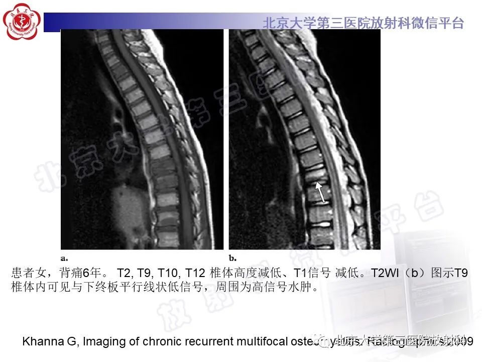 影像PPT - 【PPT】慢性复发性多灶性骨髓炎-34