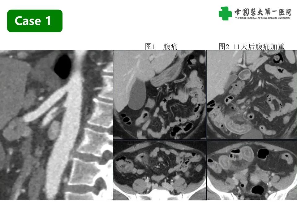 影像PPT - 【PPT】CT诊断肠系膜缺血的要点、误区与鉴别诊断-9