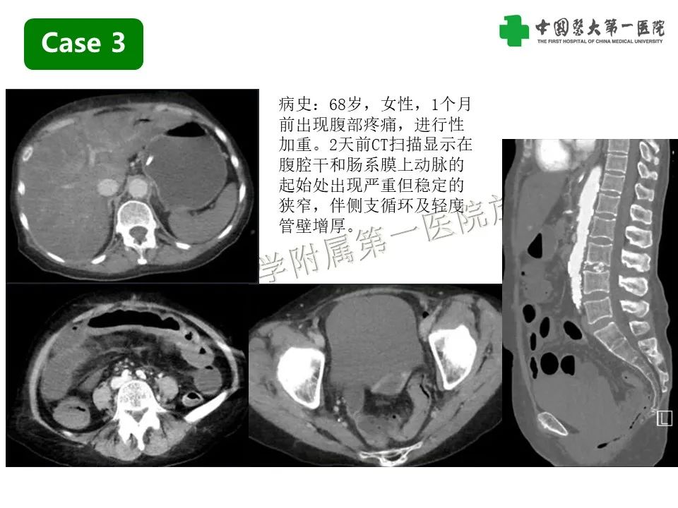 影像PPT - 【PPT】CT诊断肠系膜缺血的要点、误区与鉴别诊断-13