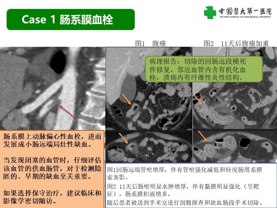 影像PPT - 【PPT】CT诊断肠系膜缺血的要点、误区与鉴别诊断-10