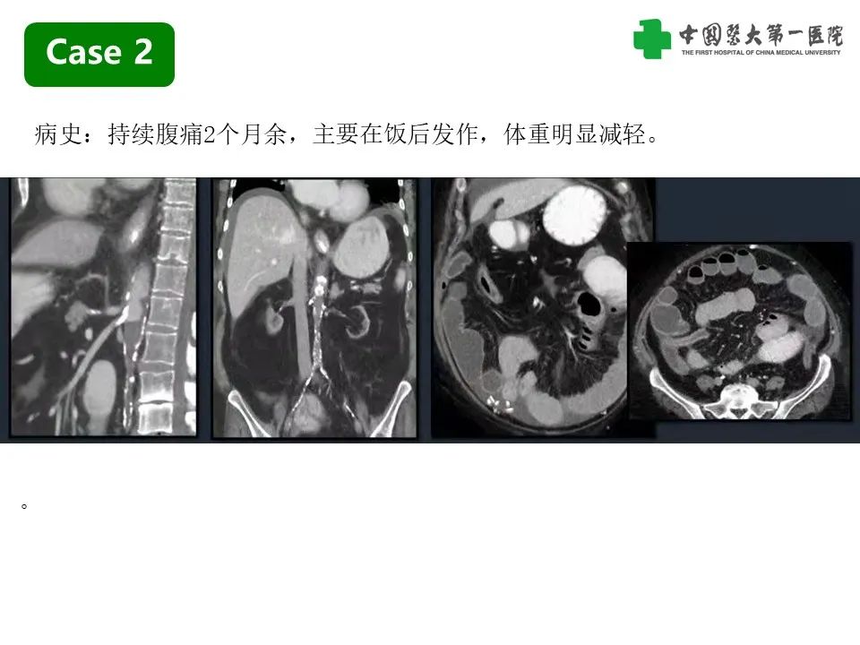 影像PPT - 【PPT】CT诊断肠系膜缺血的要点、误区与鉴别诊断-11