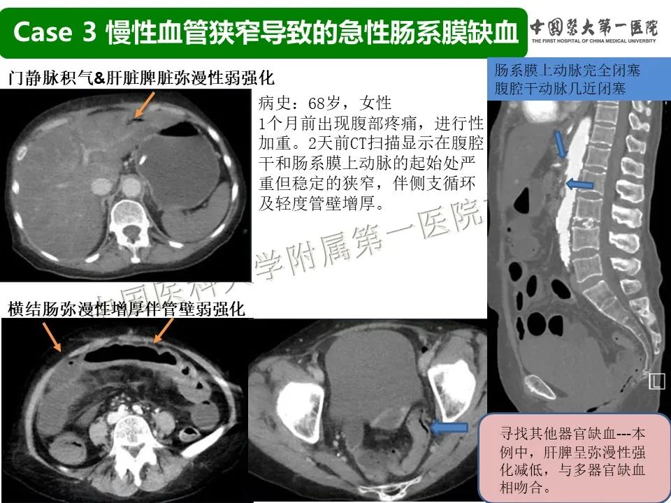 影像PPT - 【PPT】CT诊断肠系膜缺血的要点、误区与鉴别诊断-14