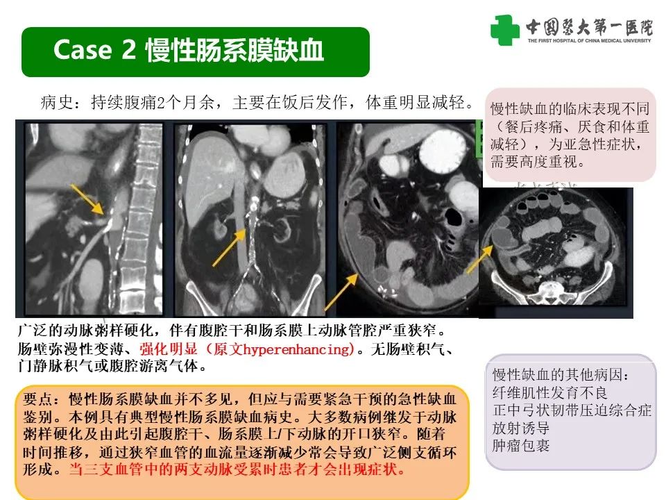 影像PPT - 【PPT】CT诊断肠系膜缺血的要点、误区与鉴别诊断-12