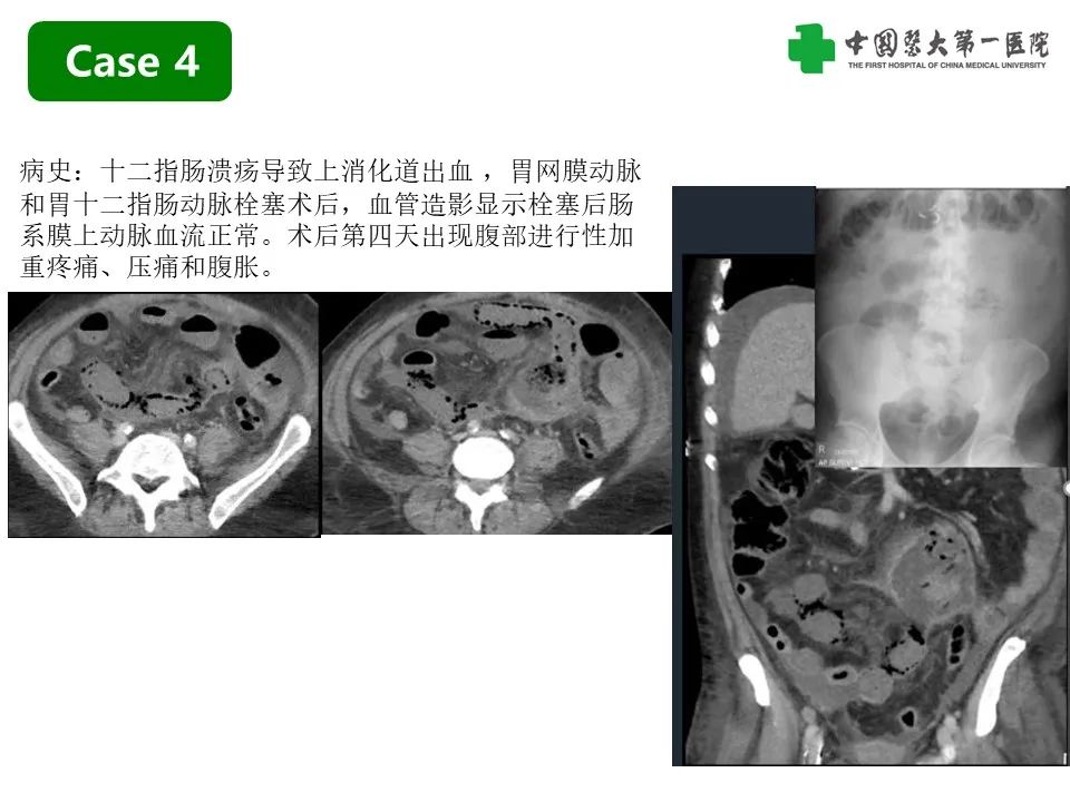 影像PPT - 【PPT】CT诊断肠系膜缺血的要点、误区与鉴别诊断-16