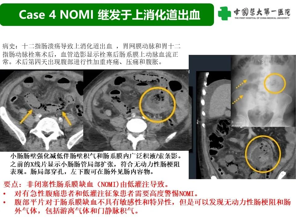 影像PPT - 【PPT】CT诊断肠系膜缺血的要点、误区与鉴别诊断-17