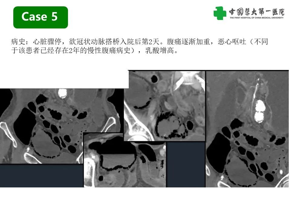 影像PPT - 【PPT】CT诊断肠系膜缺血的要点、误区与鉴别诊断-19