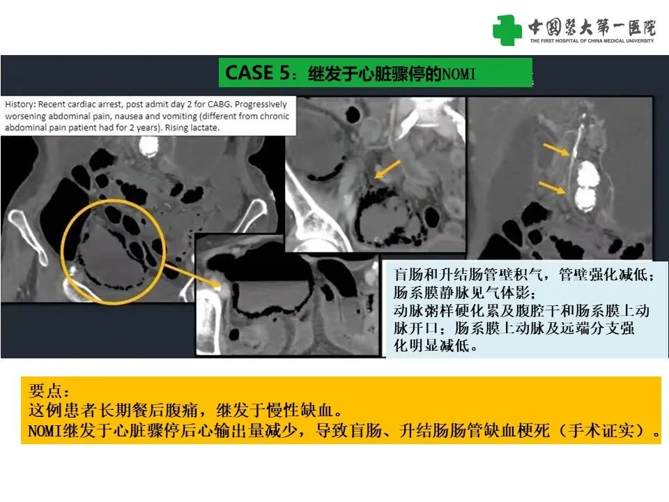 影像PPT - 【PPT】CT诊断肠系膜缺血的要点、误区与鉴别诊断-20