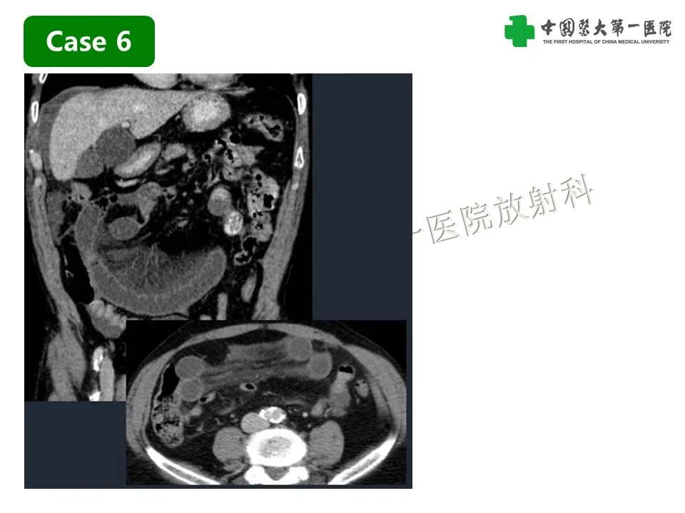 影像PPT - 【PPT】CT诊断肠系膜缺血的要点、误区与鉴别诊断-21