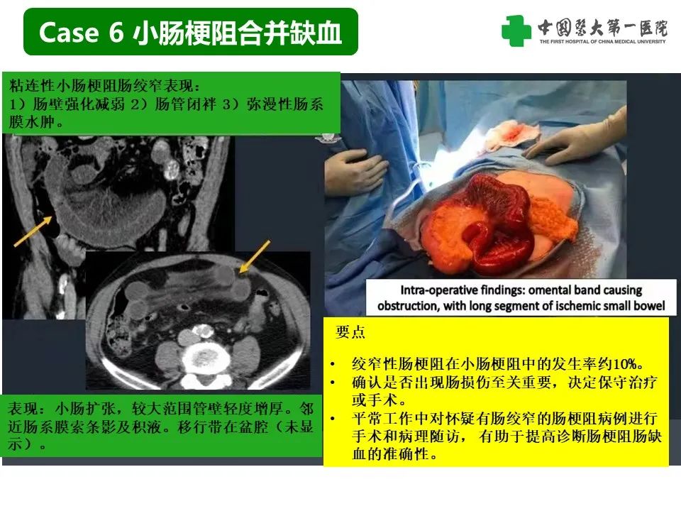 影像PPT - 【PPT】CT诊断肠系膜缺血的要点、误区与鉴别诊断-22