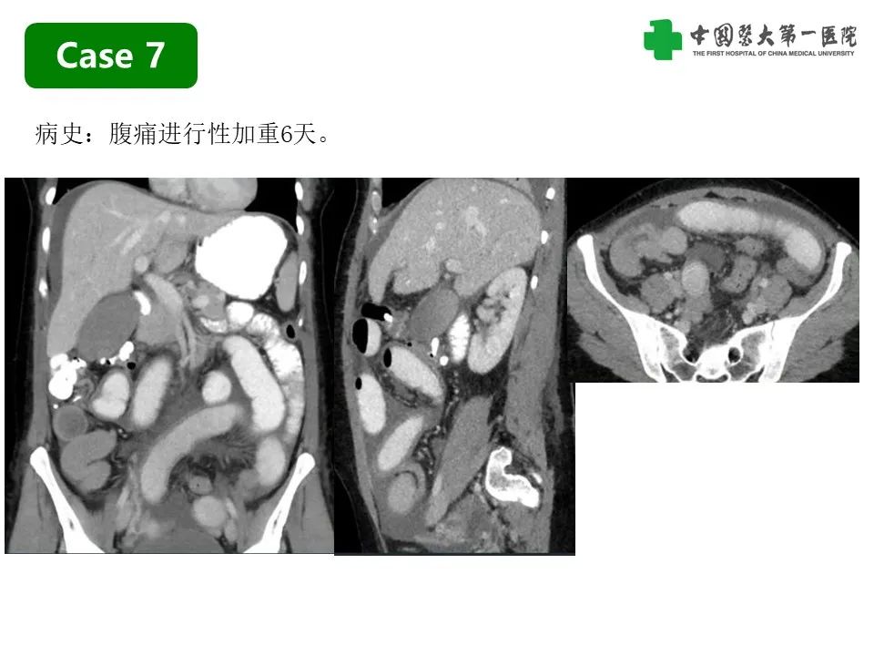 影像PPT - 【PPT】CT诊断肠系膜缺血的要点、误区与鉴别诊断-23
