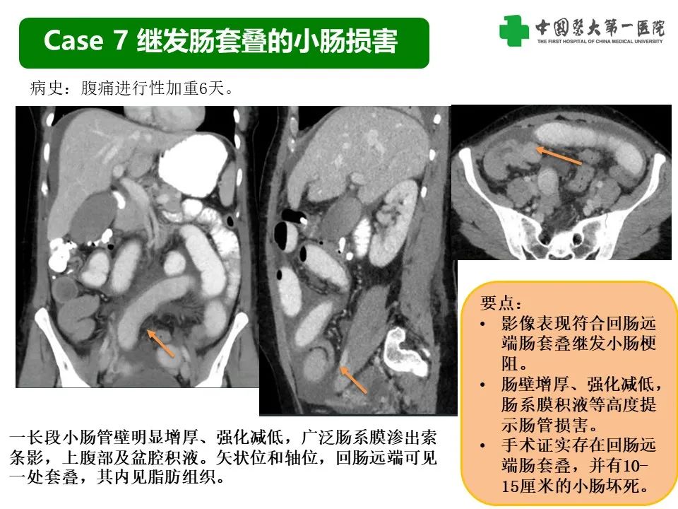 影像PPT - 【PPT】CT诊断肠系膜缺血的要点、误区与鉴别诊断-24