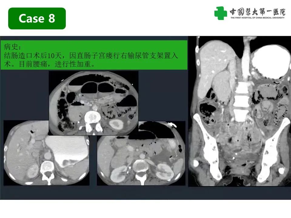 影像PPT - 【PPT】CT诊断肠系膜缺血的要点、误区与鉴别诊断-25
