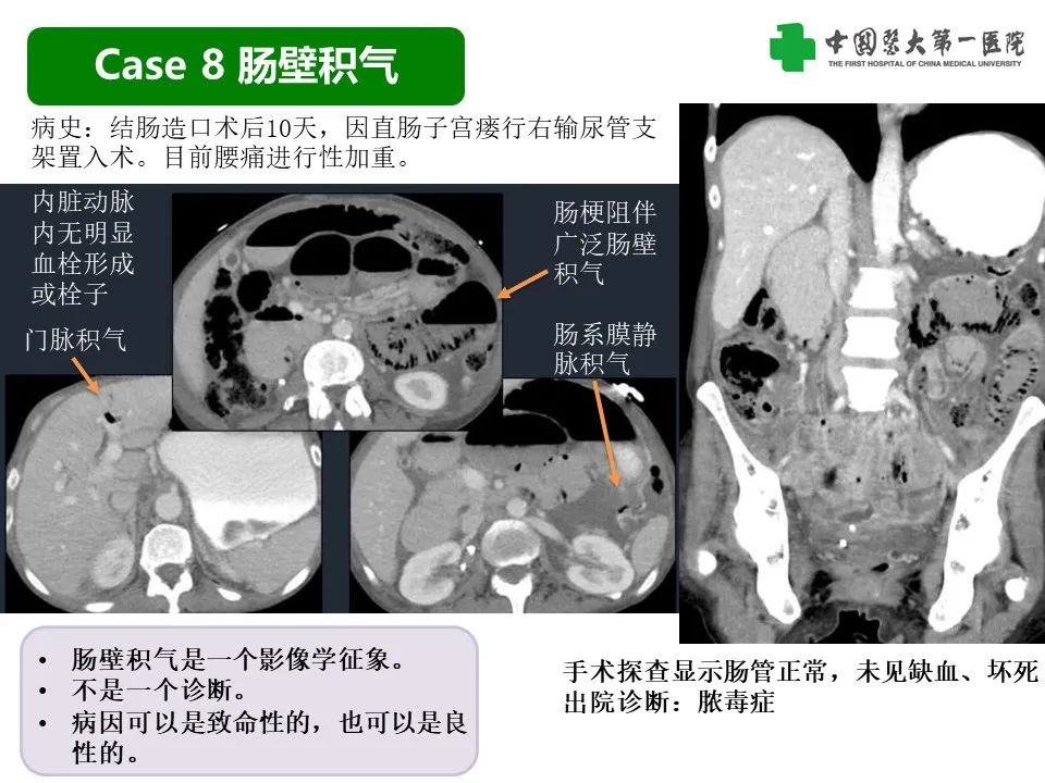 影像PPT - 【PPT】CT诊断肠系膜缺血的要点、误区与鉴别诊断-26