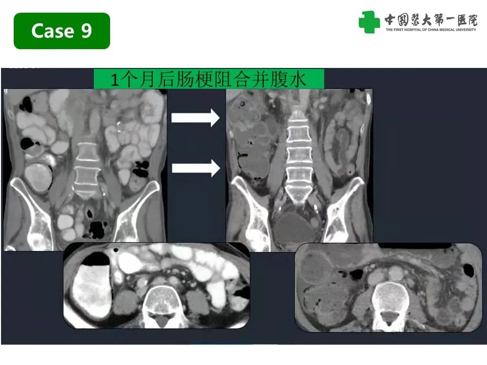 影像PPT - 【PPT】CT诊断肠系膜缺血的要点、误区与鉴别诊断-28