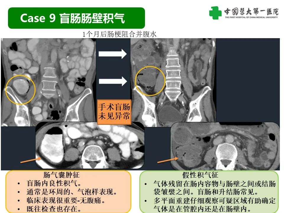 影像PPT - 【PPT】CT诊断肠系膜缺血的要点、误区与鉴别诊断-29