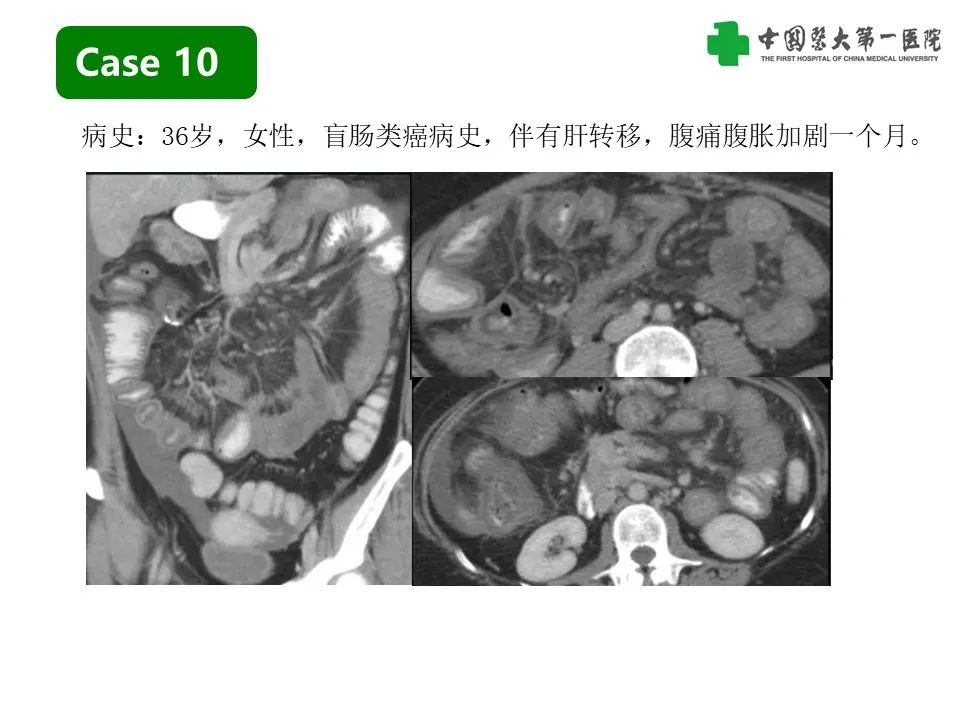 影像PPT - 【PPT】CT诊断肠系膜缺血的要点、误区与鉴别诊断-30