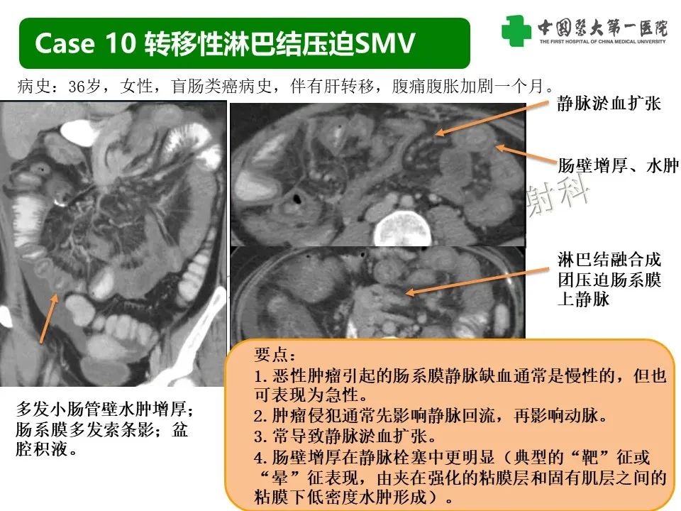 影像PPT - 【PPT】CT诊断肠系膜缺血的要点、误区与鉴别诊断-31