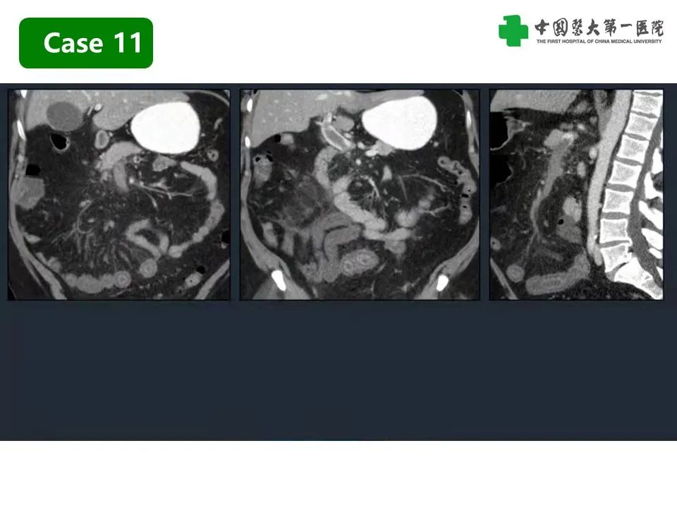 影像PPT - 【PPT】CT诊断肠系膜缺血的要点、误区与鉴别诊断-32