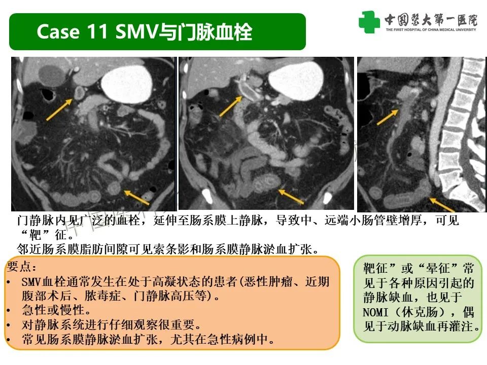 影像PPT - 【PPT】CT诊断肠系膜缺血的要点、误区与鉴别诊断-33