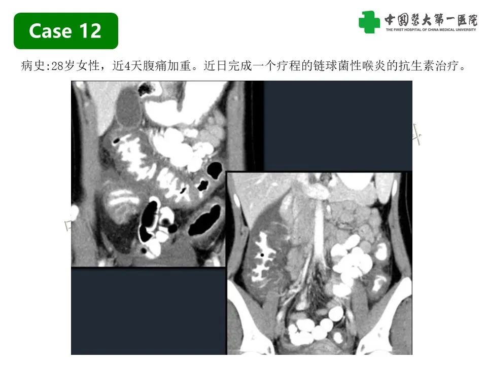影像PPT - 【PPT】CT诊断肠系膜缺血的要点、误区与鉴别诊断-34