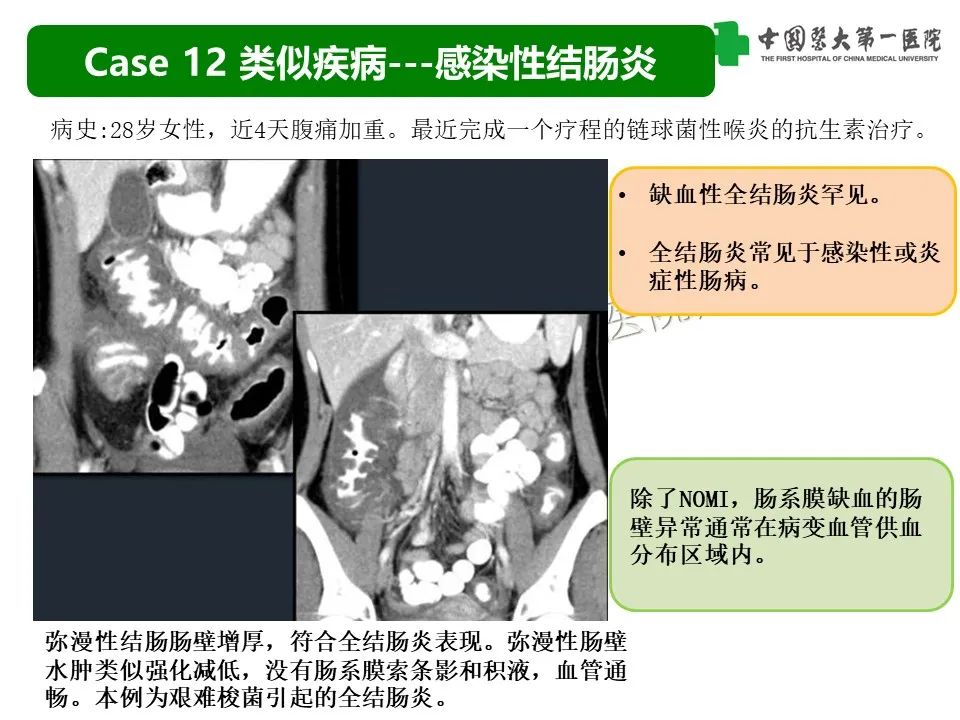影像PPT - 【PPT】CT诊断肠系膜缺血的要点、误区与鉴别诊断-35