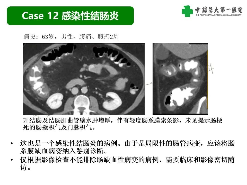 影像PPT - 【PPT】CT诊断肠系膜缺血的要点、误区与鉴别诊断-36