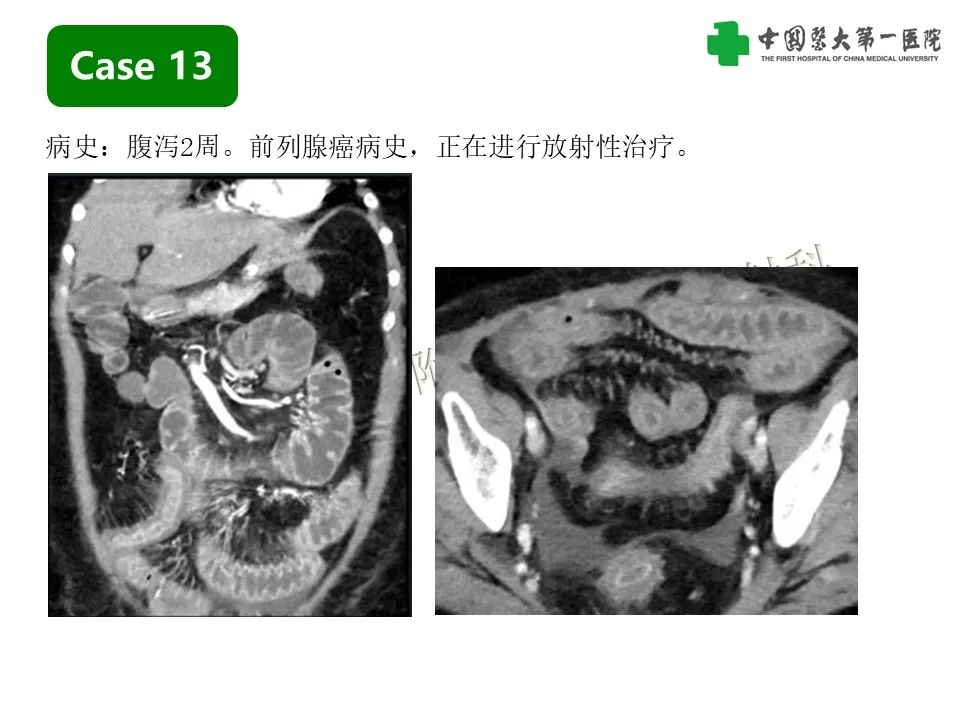 影像PPT - 【PPT】CT诊断肠系膜缺血的要点、误区与鉴别诊断-37