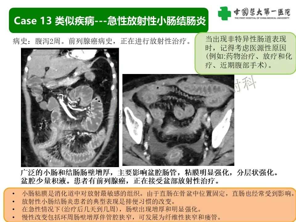 影像PPT - 【PPT】CT诊断肠系膜缺血的要点、误区与鉴别诊断-38