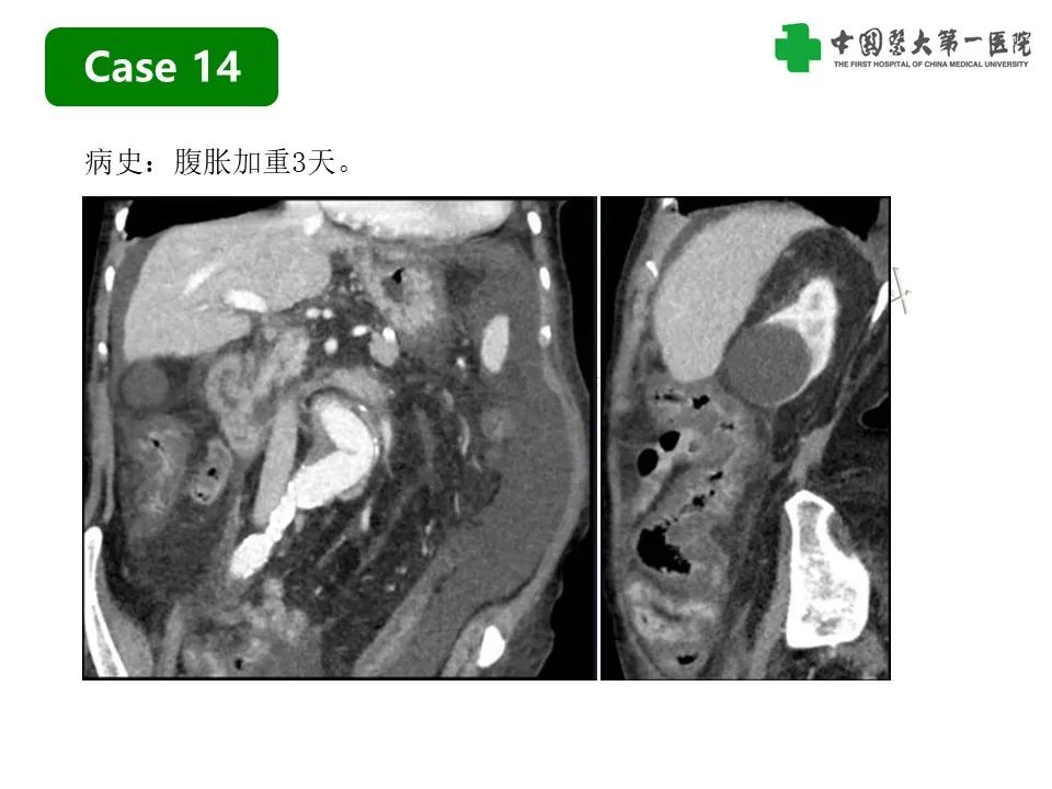 影像PPT - 【PPT】CT诊断肠系膜缺血的要点、误区与鉴别诊断-39