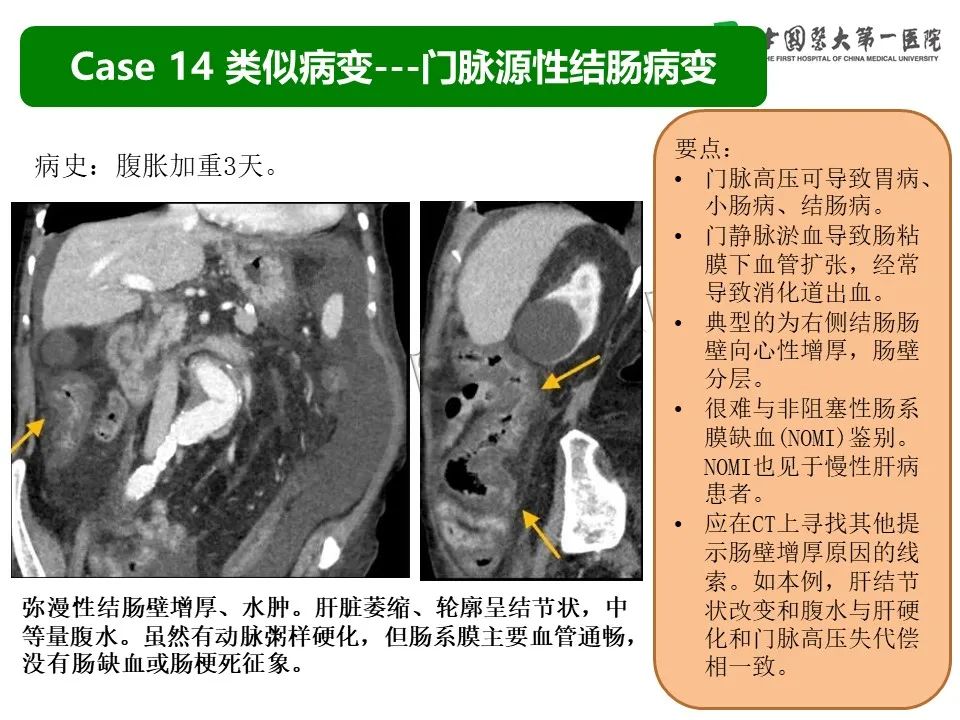 影像PPT - 【PPT】CT诊断肠系膜缺血的要点、误区与鉴别诊断-40