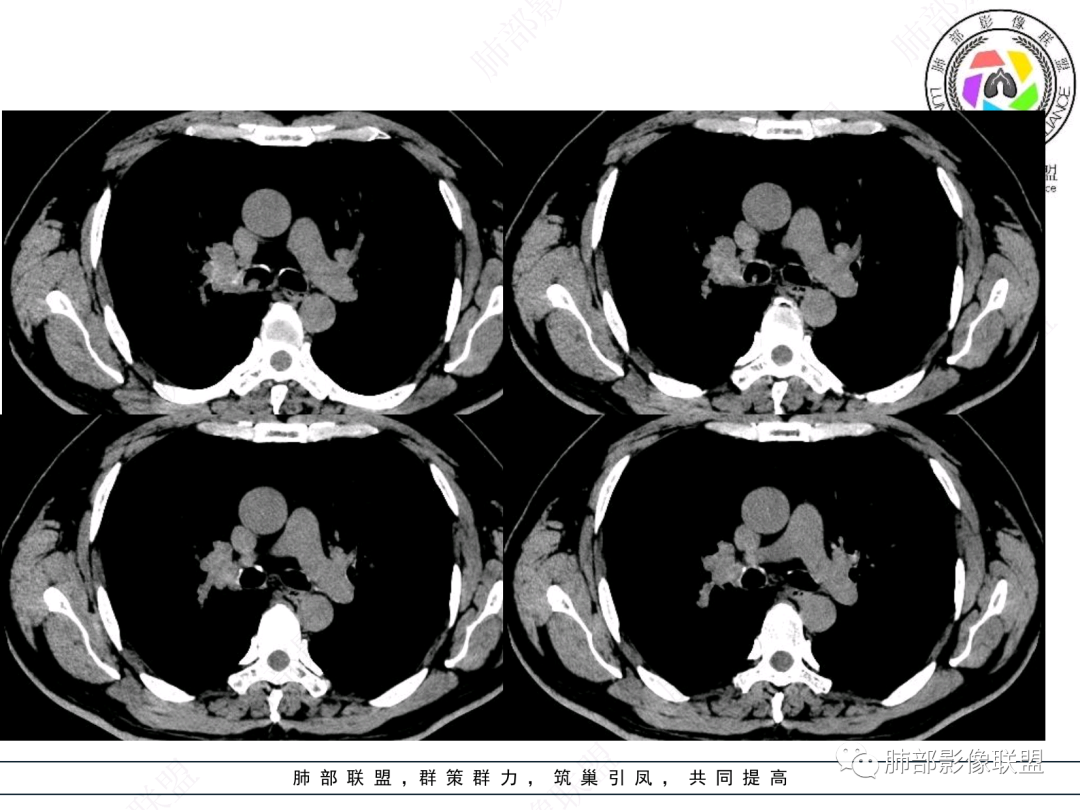 影像PPT - 【病例】支气管神经内分泌癌1例CT影像-25 影像PPT - 【病例】支气管神经内分泌癌1例CT影像-25