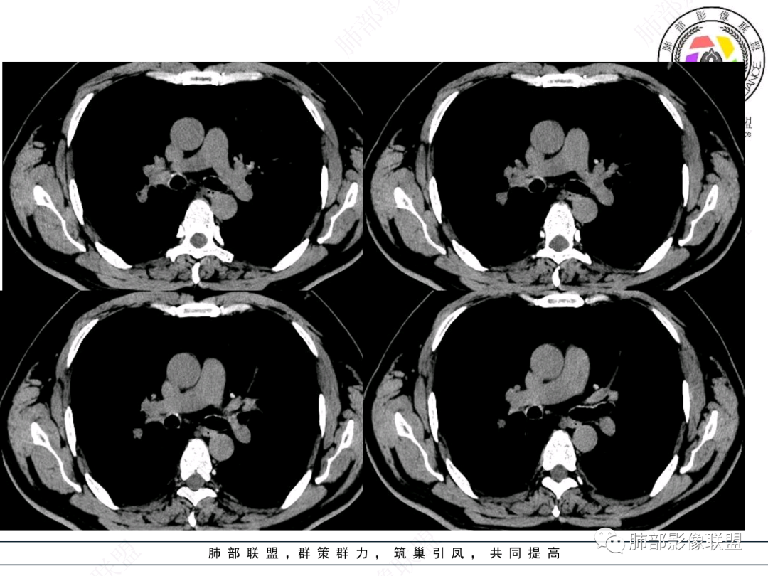 影像PPT - 【病例】支气管神经内分泌癌1例CT影像-26 影像PPT - 【病例】支气管神经内分泌癌1例CT影像-26