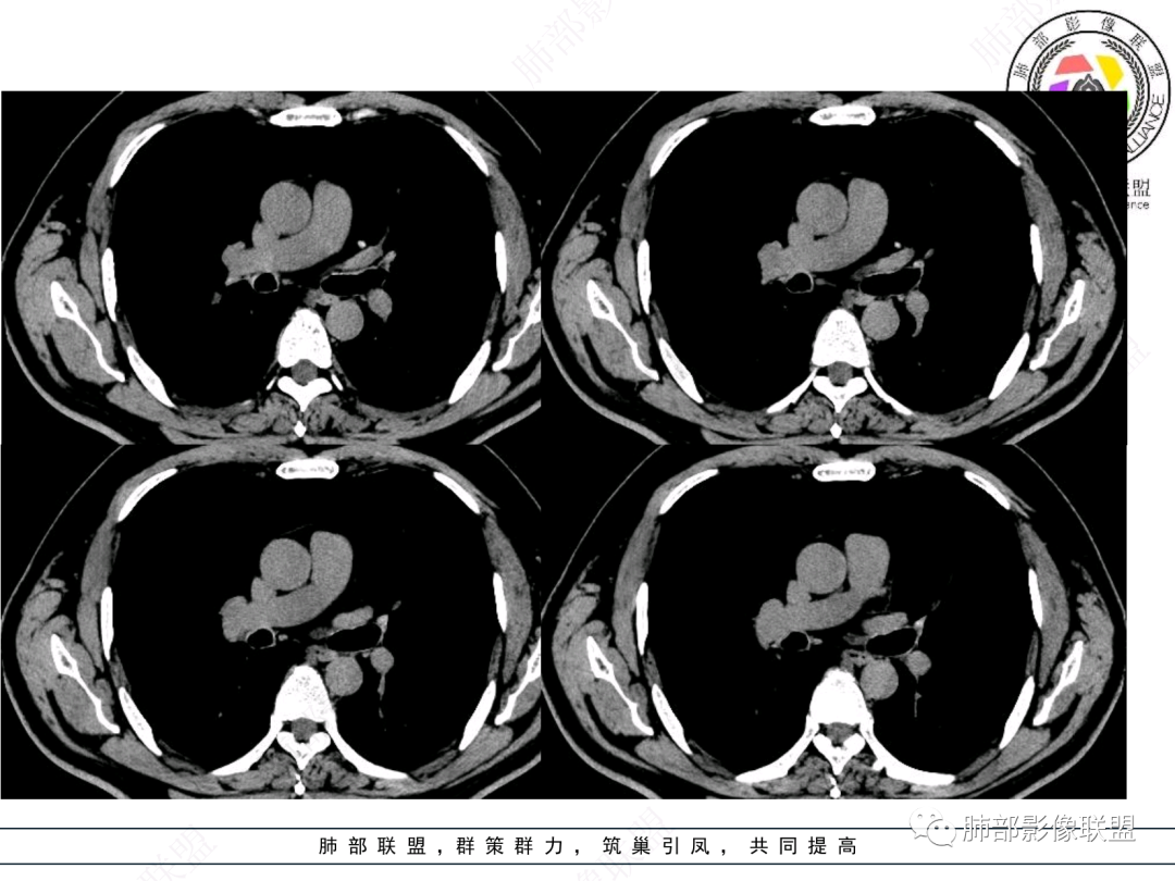 影像PPT - 【病例】支气管神经内分泌癌1例CT影像-27 影像PPT - 【病例】支气管神经内分泌癌1例CT影像-27