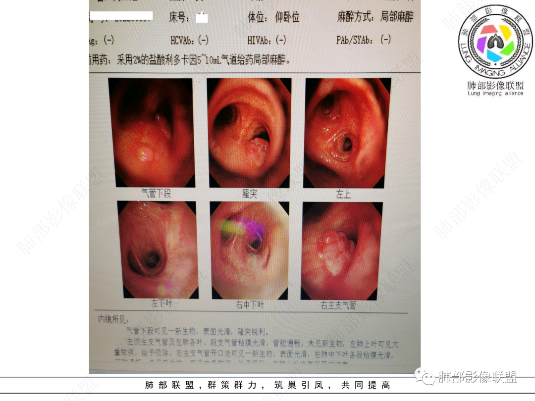 影像PPT - 【病例】支气管神经内分泌癌1例CT影像-32 影像PPT - 【病例】支气管神经内分泌癌1例CT影像-32