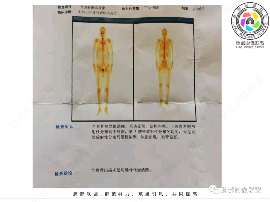 影像PPT - 【病例】支气管神经内分泌癌1例CT影像-33 影像PPT - 【病例】支气管神经内分泌癌1例CT影像-33